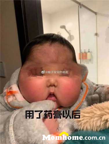 7个月女婴成“大头娃娃”，湿疹怎么治疗？